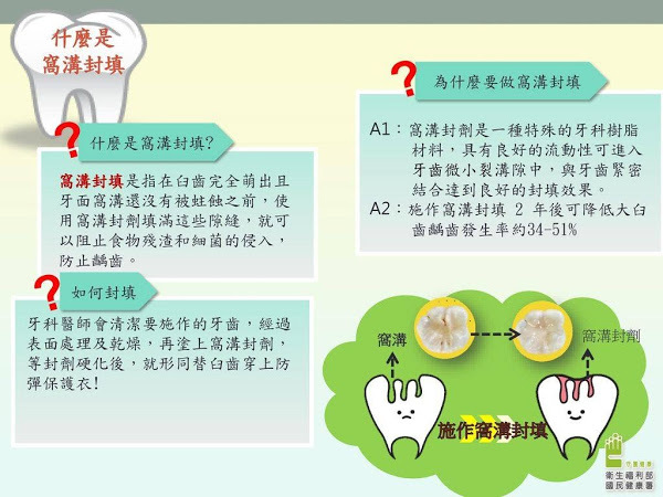 窩溝封填